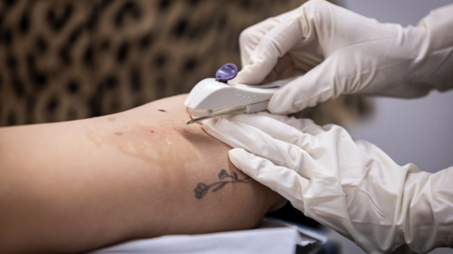 Rede pública amplia o acesso gratuito ao Implanon e garante mais autonomia às mulheres